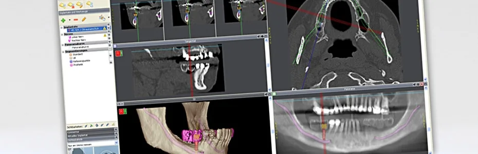 Dreidimensionale Implantatplanung am Bildschirm
