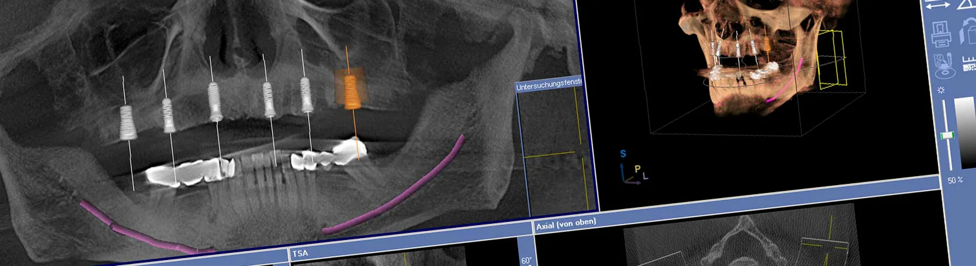 3D-Planung mehrerer Implantate am Bildschirm