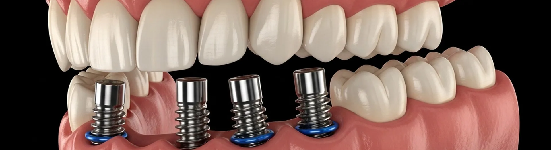 Illustration einer implantatgetragenen Zahnreihe im Unterkiefer