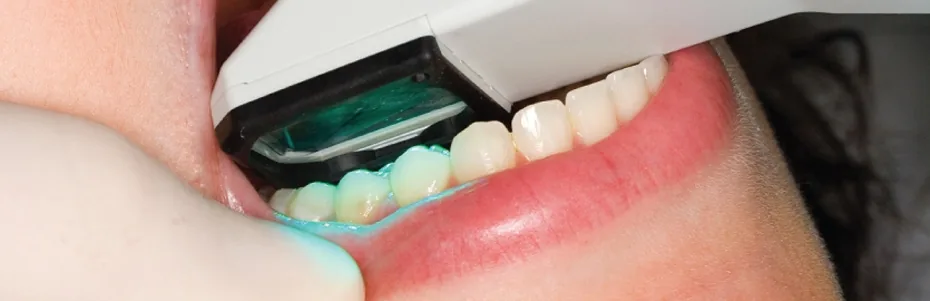 Anwendung eines intraoralen Scanners